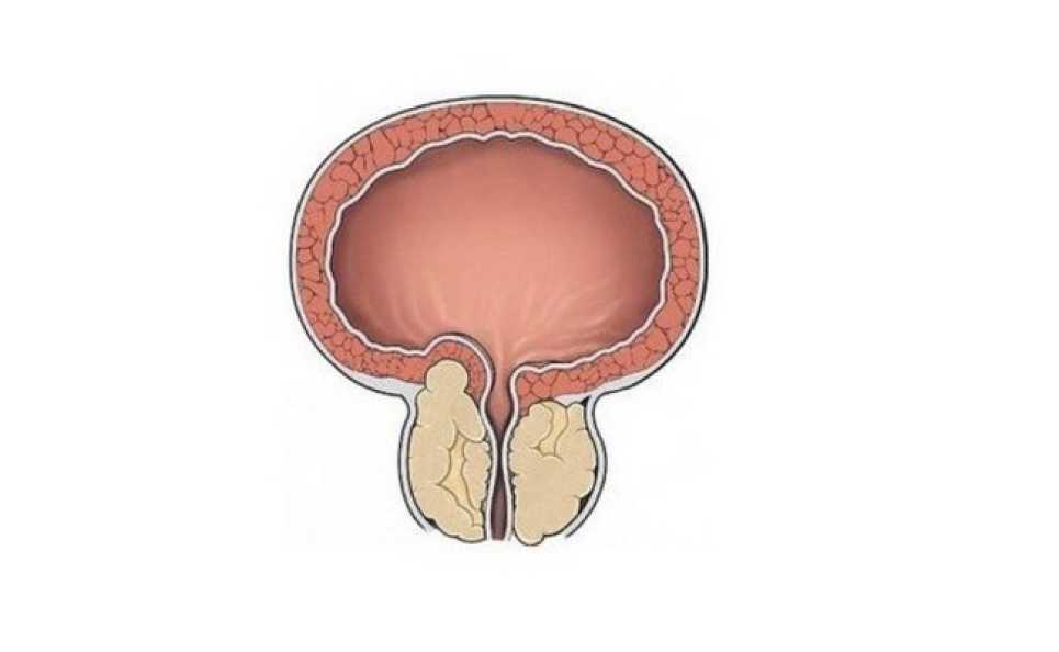 Предстательная железа острая задержка мочи. Аденома мочевого пузыря. Мочевой пузырь и простата. Простатит вектор.